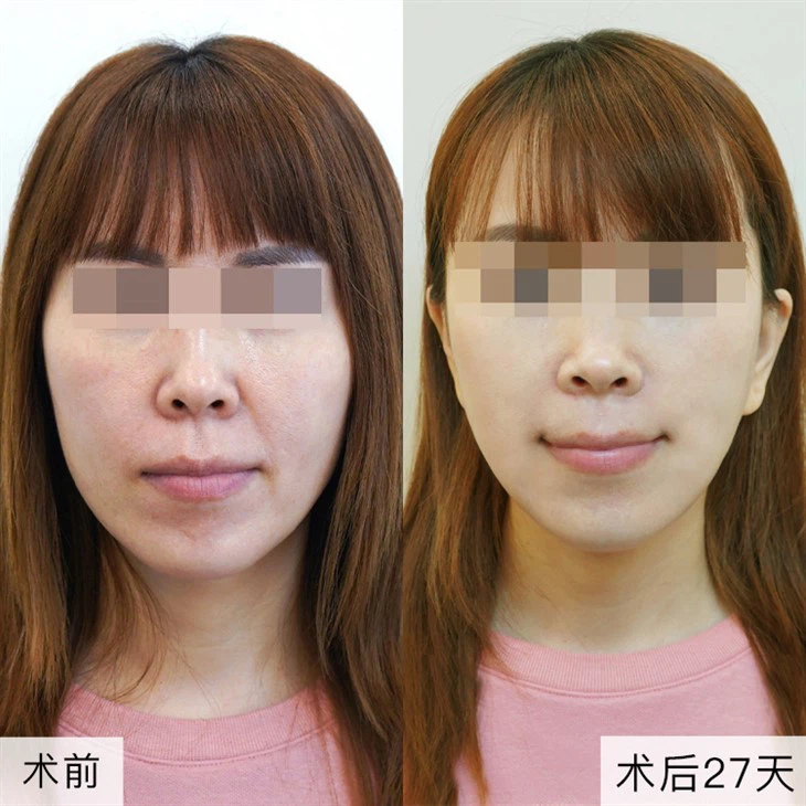 4Neck Wrinkle Lift Surgery